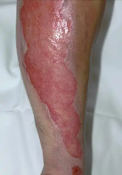 吃火锅被烧伤的女孩状况