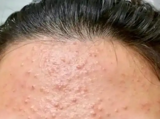 脸上长密密麻麻的闭口粉刺小疙瘩,应该怎么办?