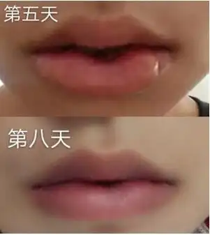 分享一下做的厚唇改薄真实案例 效果不错_整容日记_整形前后对比照