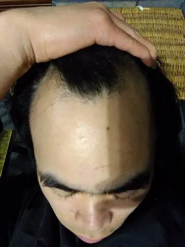 脱发好几年,头发很茂密,就前面两边秃