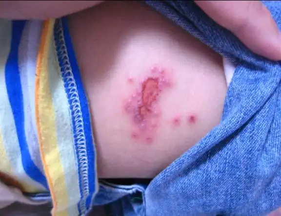 请问我宝宝得的是什么皮肤病啊(附图)