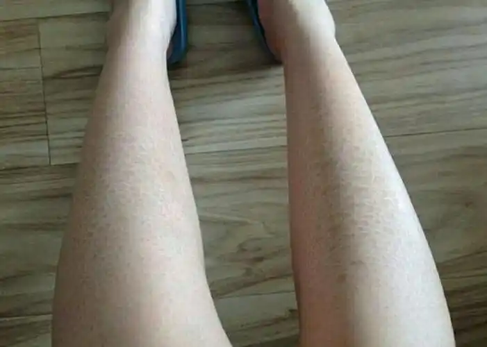 鱼鳞病_西安北方中医皮肤病医院