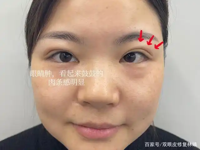 不过很多人最关心的还是"肿眼泡"到底适不适合做双眼皮呢?