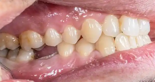 「公开报道」牙齿缺失做牙齿修复好不好?