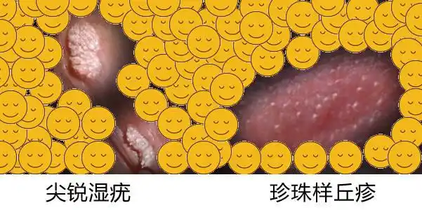 假性湿疣与尖锐湿疣是不同的两种情况,前者一般无需治疗,也不传染.