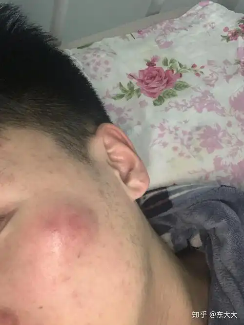 记一次脸上张疖子的悲惨遭遇