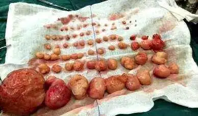 经历7次流产的女子, 肚子似怀孕4个月, 打开肚子后医生吓得腿发颤