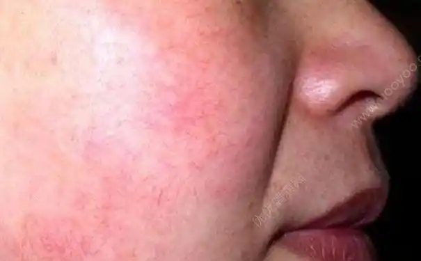 换季皮肤有红血丝怎么办皮肤有红血丝的原因多图