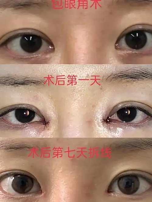 内眼角开大了,显老气,找院长包眼角,自然又适合自己_圈子-新氧美容