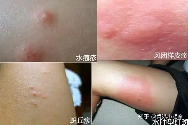 宝宝最常见的5种疹子香港小顽童特护珍珠膏一瓶解决