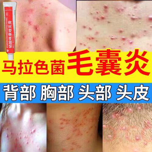 1盒装【国药甄选治毛囊炎】