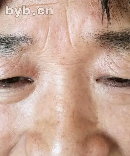 她的情况,是全身经络堵的很厉害,手掌上有明显的鼻横纹和川字纹