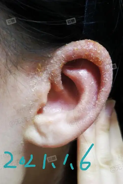 对抗耳朵身体湿疹反复