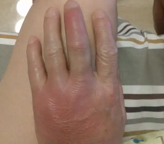 该阶段的痛风症状主要表现为脚踝关节或脚指,手臂,手指关节处疼痛